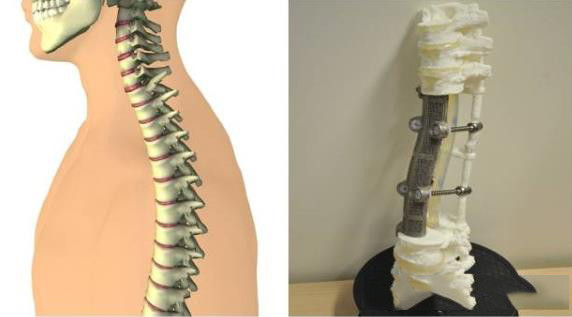 3D打印醫(yī)療應用成功案例 北醫(yī)三院3D打印定制人工椎體植入術(shù)