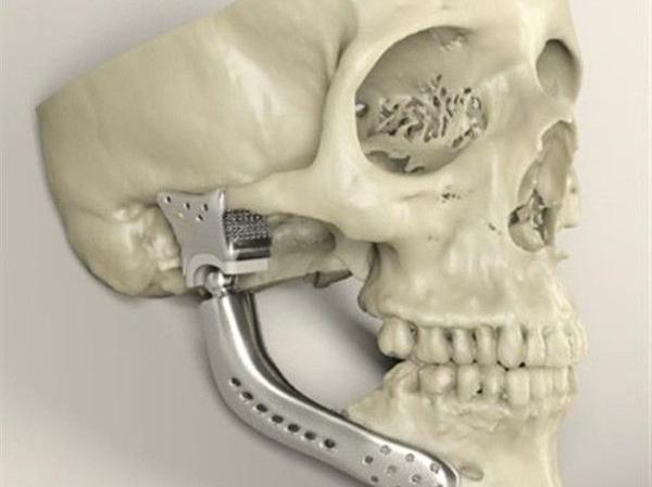 簡述3D打印技術在醫療行業應用情況_e鍵3D打印服務 簡述3D打印技術在醫療行業應用情況_e鍵3D打印服務