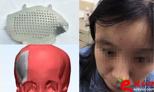醫療3d打印應用,醫用3d打印,3D打印假肢,3D打印脊椎,3D打印心臟,e鍵打印,3d打印服務 3D打印的顱骨假體，非常適用于發際外的顱骨缺損、病變置換，將使患者的面容恢復到正常形態，完美解決了傳統顱骨修補存在的美容問題。據悉，3D打印個性化顱骨假體修補技術已獲國家重點研發計劃資助，能為一批病人免費提供假體，并能減免一些檢查和治療費用。未來將實行72小時的3D假體個性化顱骨修補術，造福更多的患者。