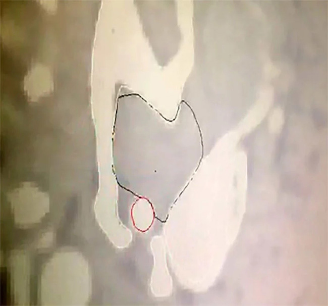 術前CT骨腫瘤位置圖