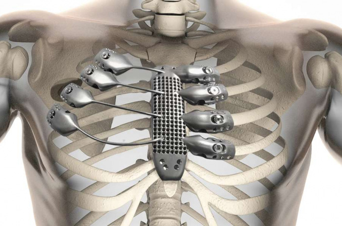 3D打印醫(yī)療器械將在我國(guó)迎來(lái)蓬勃發(fā)展